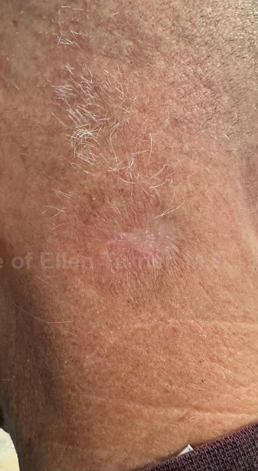 SRT-100 Before and After Case 75 After