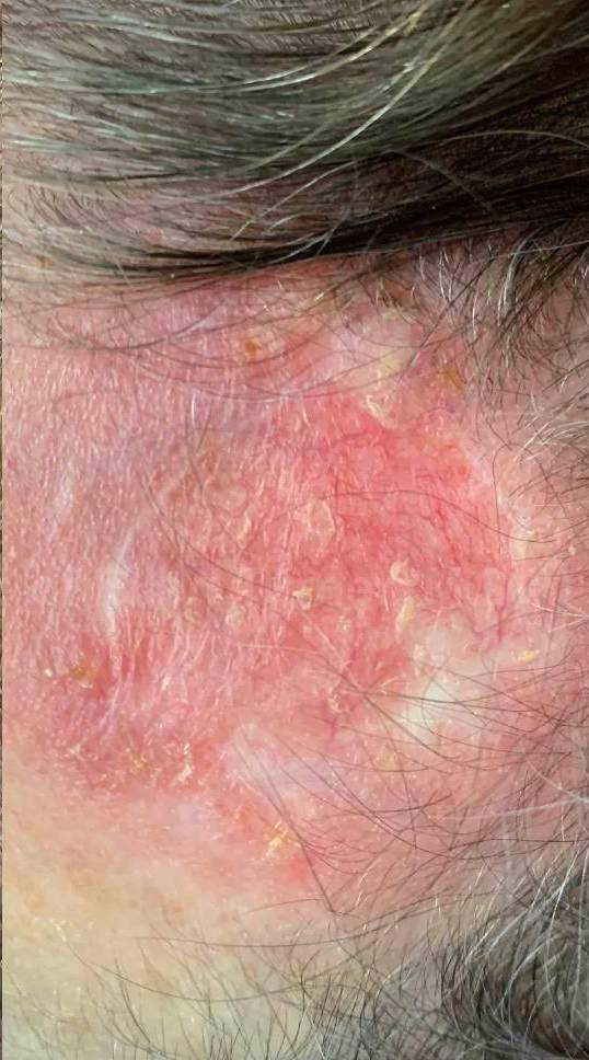 SRT-100 Before and After Case 73 After