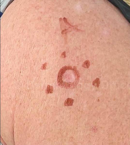 SRT-100 Before and After Case 72 Before