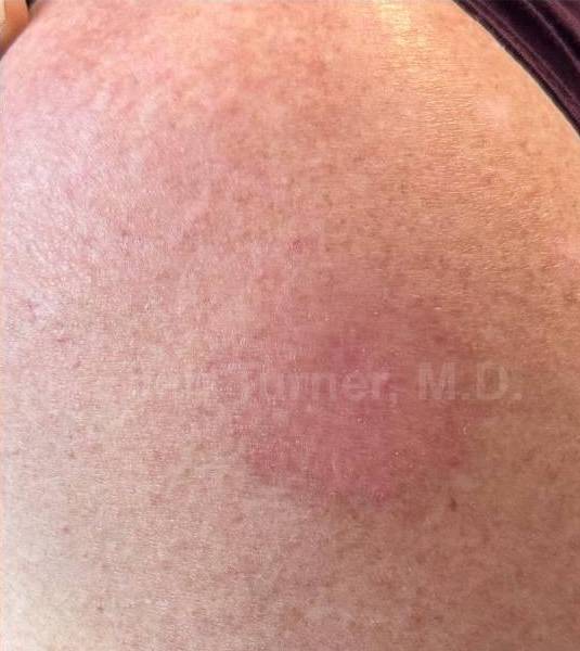 SRT-100 Before and After Case 72 After