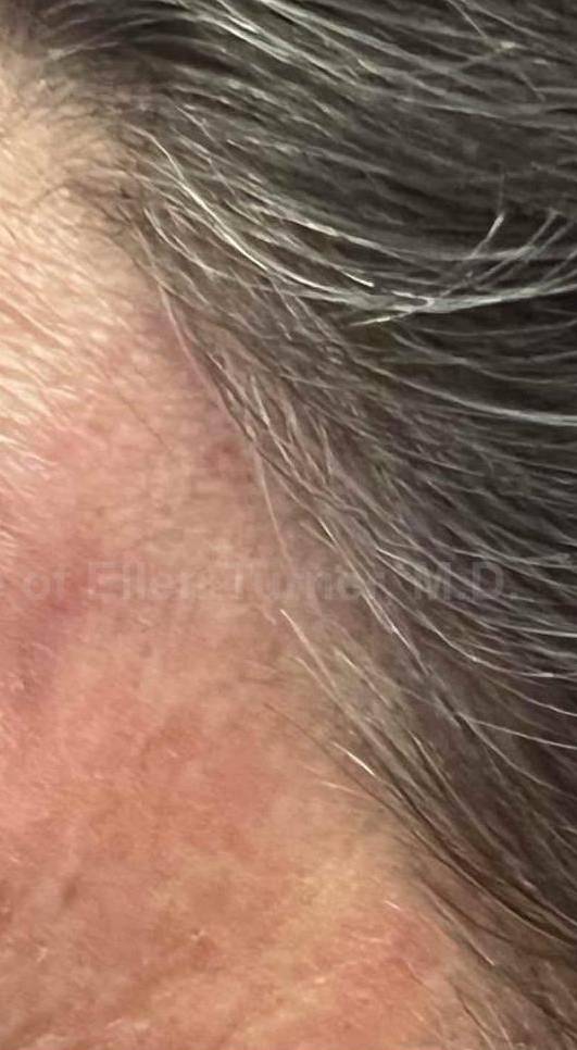 SRT-100 Before and After Case 71 After