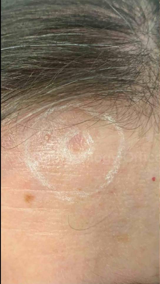 SRT-100 Before and After Case 69 Before