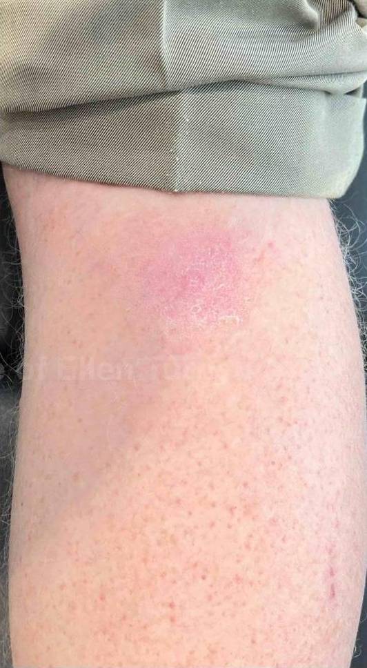 SRT-100 Before and After Case 68 After