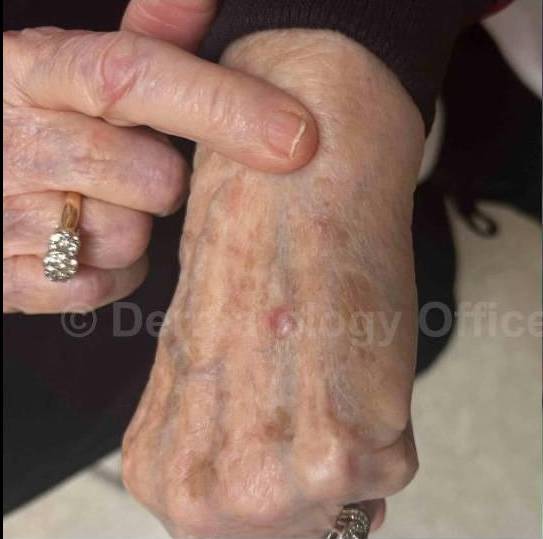 SRT-100 Before and After Case 67 Before