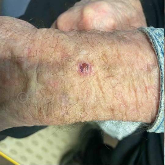 SRT-100 Before and After Case 65 Before