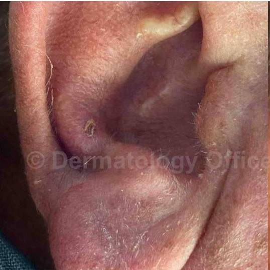 SRT-100 Before and After Case 64 Before