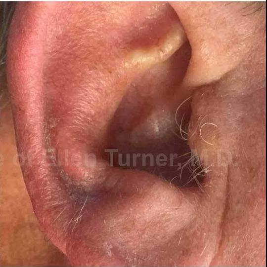 SRT-100 Before and After Case 64 After