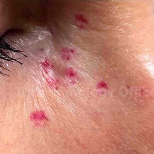 SRT-100 Before and After Case 63 Before