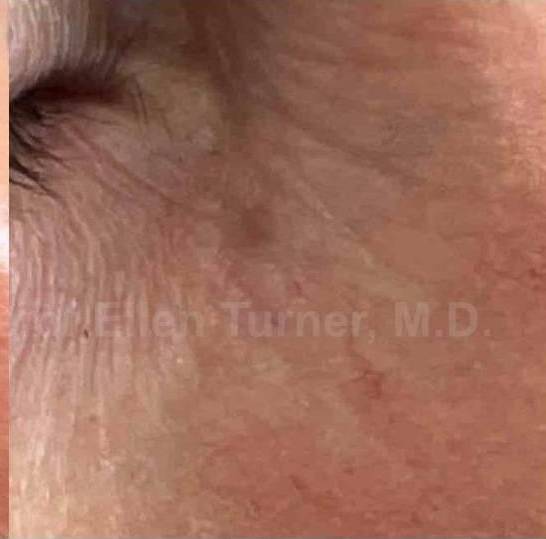 SRT-100 Before and After Case 63 After