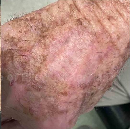 SRT-100 Before and After Case 61 After