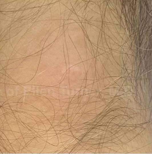 SRT-100 Before and After Case 60 After