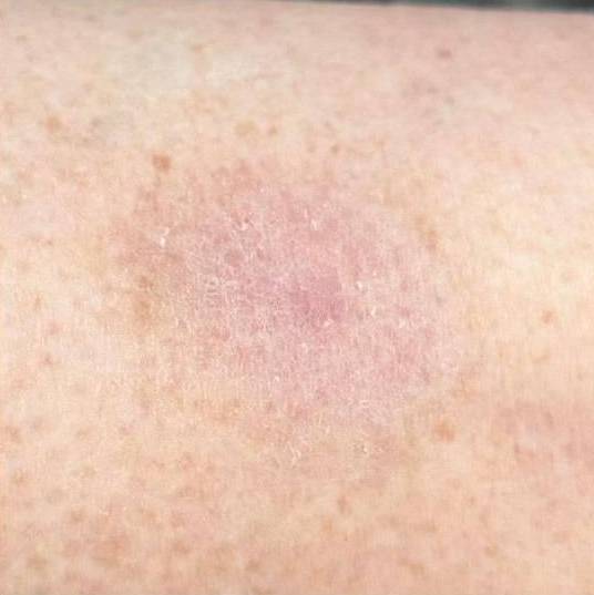 SRT-100 Before and After Case 59 After