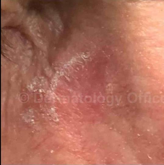 SRT-100 Before and After Case 58 Before