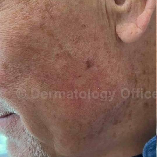 SRT-100 Before and After Case 57 Before