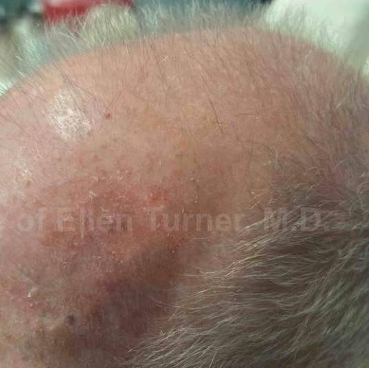 SRT-100 Before and After Case 55 After