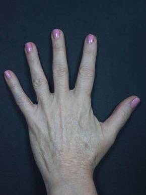 Radiesse Hands (2 Syringes) Before and After Case 6 Before