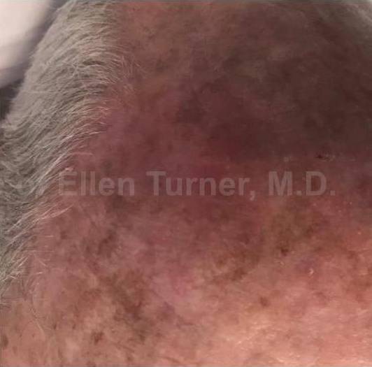 SRT-100 Before and After Case 54 After