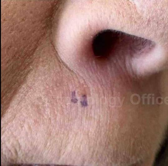 SRT-100 Before and After Case 53 Before