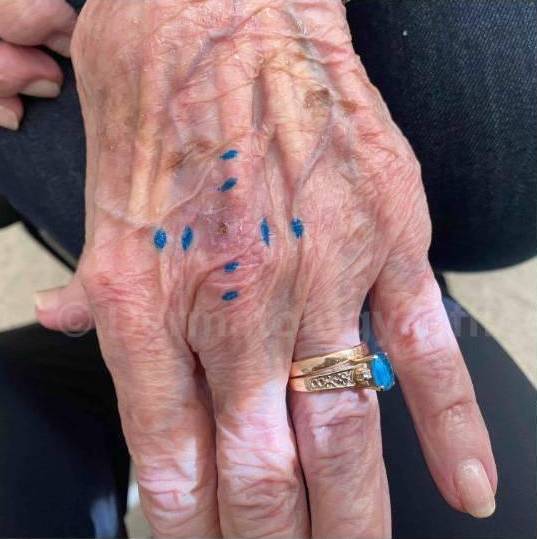 SRT-100 Before and After Case 52 Before