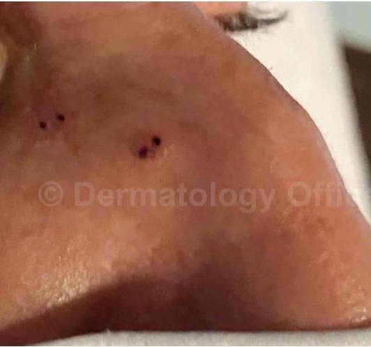 SRT-100 Before and After Case 51 Before