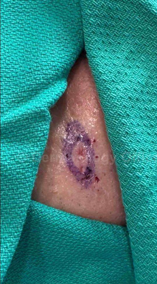 Cyst Removal Before and After Case-26 Before