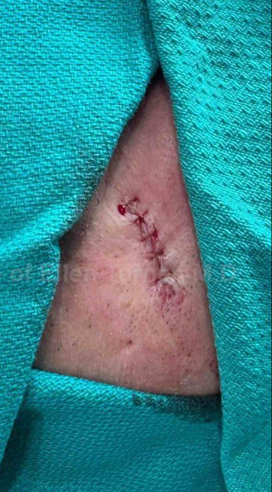 Cyst Removal Before and After Case-26 After