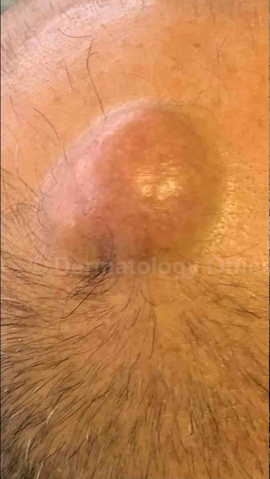 Cyst Removal Before and After Case- 25 Before
