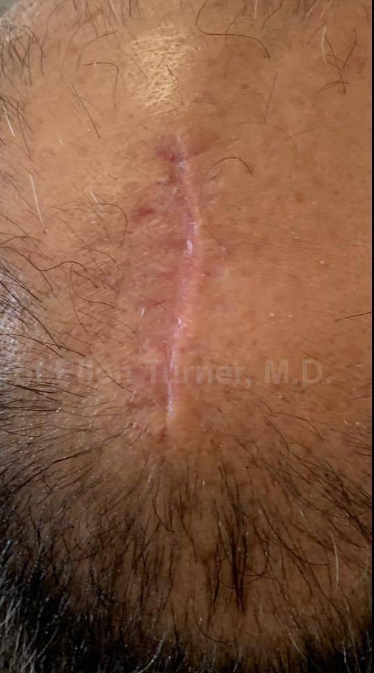 Cyst Removal Before and After Case- 25 After