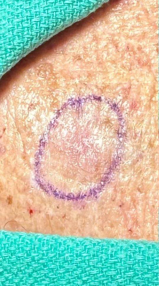 Cyst Removal Before and After Case-27 Before