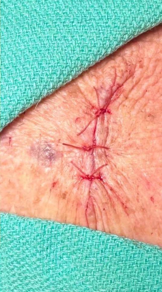 Cyst Removal Before and After Case-27 After