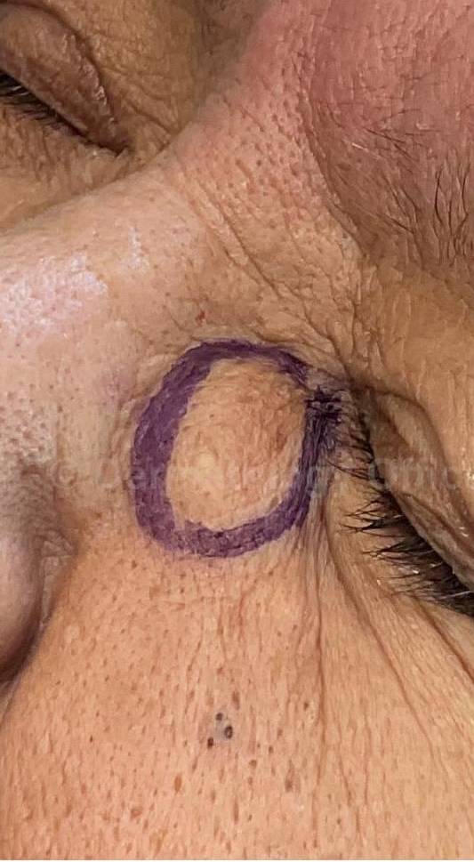 Cyst Removal Before and After Case-29 Before