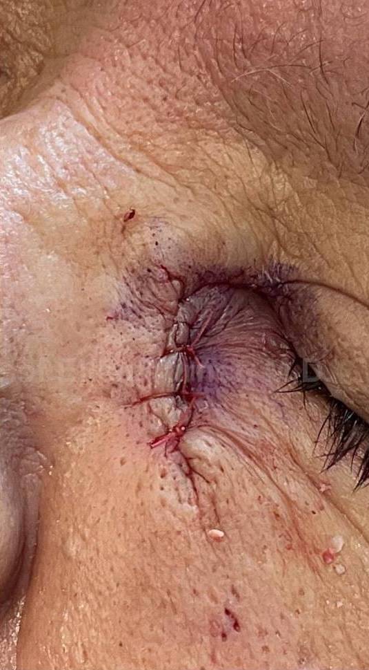 Cyst Removal Before and After Case-29 After