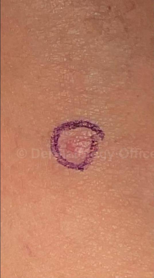 Cyst Removal Before and After Case-28 Before