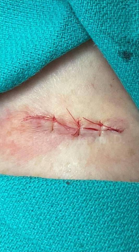 Cyst Removal Before and After Case-28 After