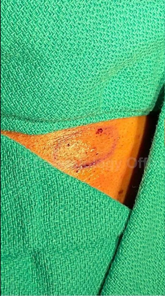 Cyst Removal Before and After Case- 30 Before