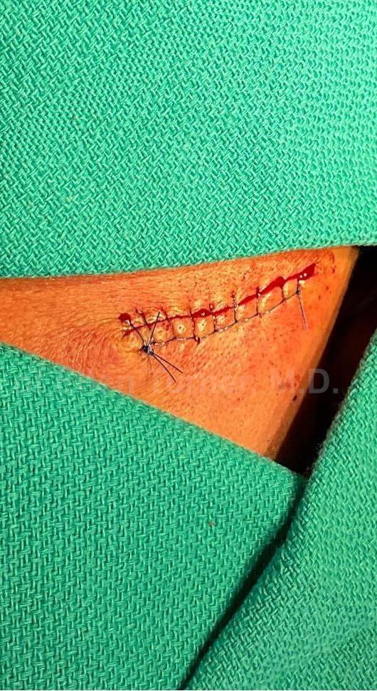 Cyst Removal Before and After Case- 30 After