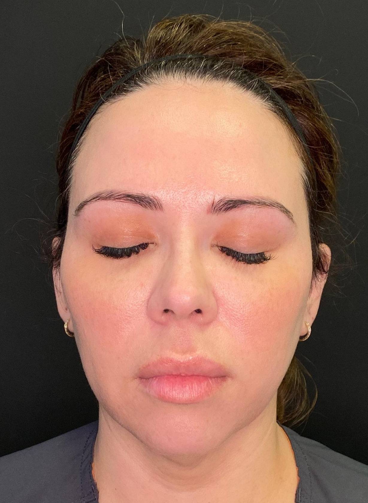Teoxane RHA Filler (8 Syringes RHA4) Case 1 Before