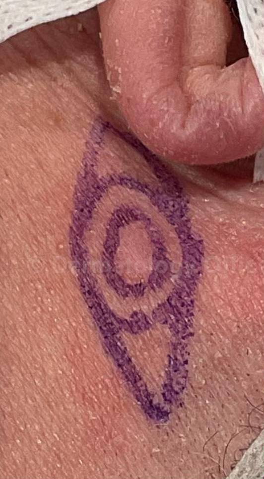 Cyst Removal Before and After Case-31 Before