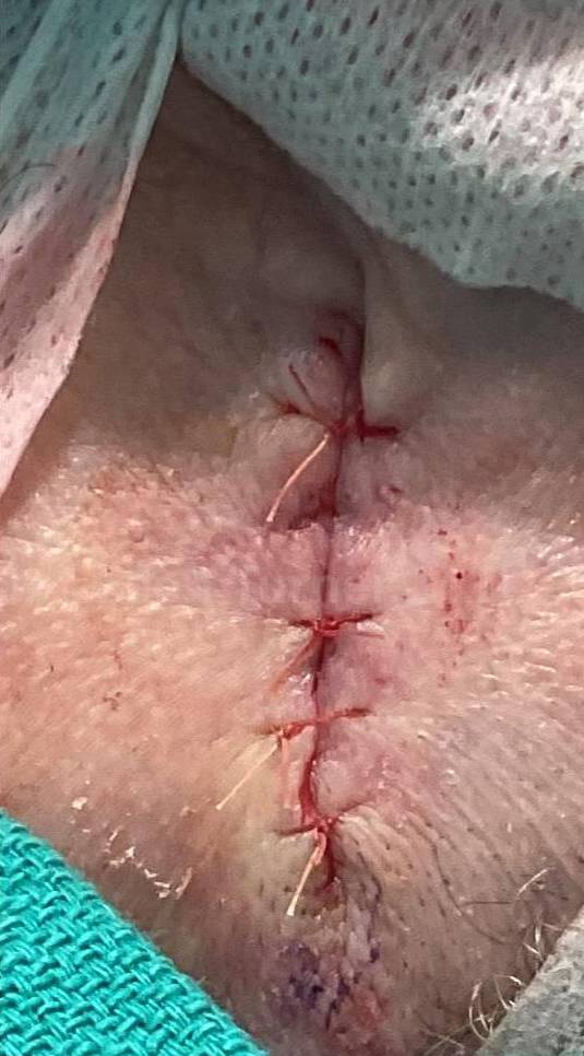 Cyst Removal Before and After Case-31 After