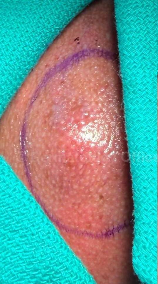 Cyst Removal Before and After Case-41 Before