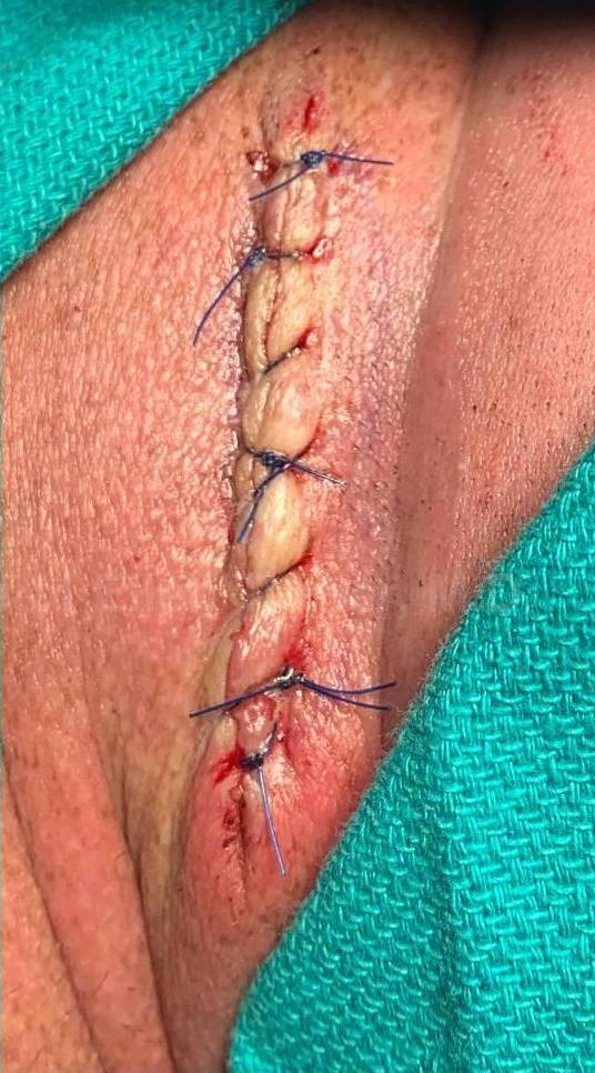 Cyst Removal Before and After Case-41 After