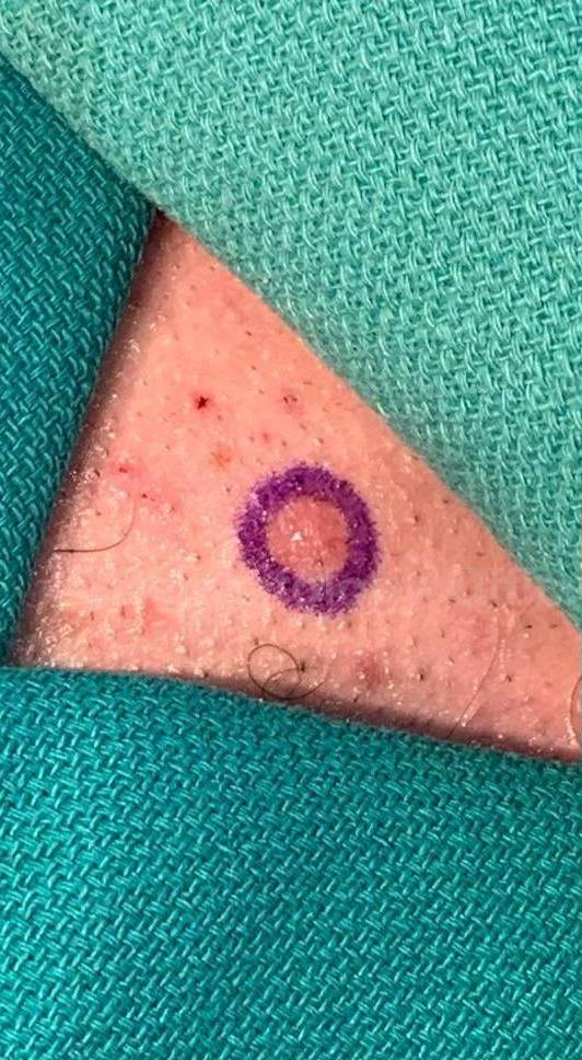 Cyst Removal Before and After Case-40 Before