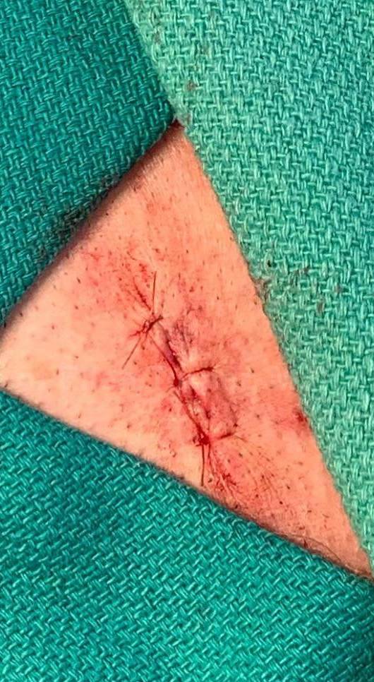 Cyst Removal Before and After Case-40 After