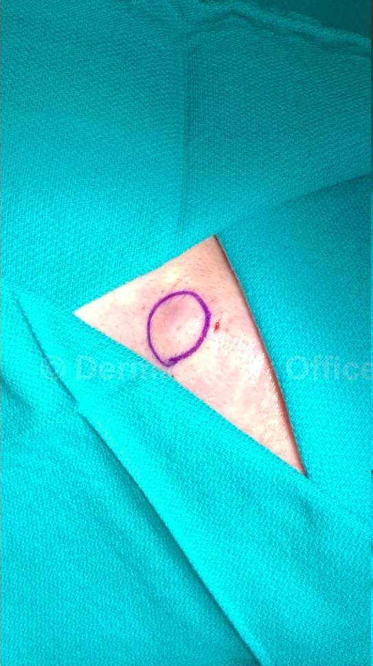 Cyst Removal Before and After Case-39 Before