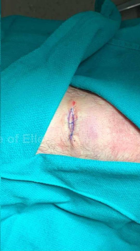 Cyst Removal Before and After Case-39 After