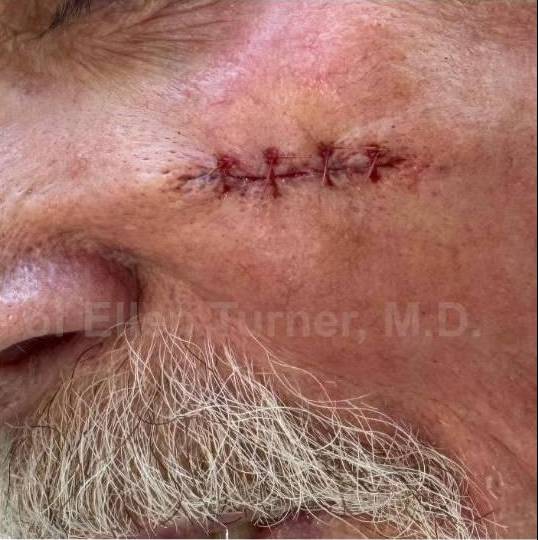 Cyst Removal Before and After Case-38 After