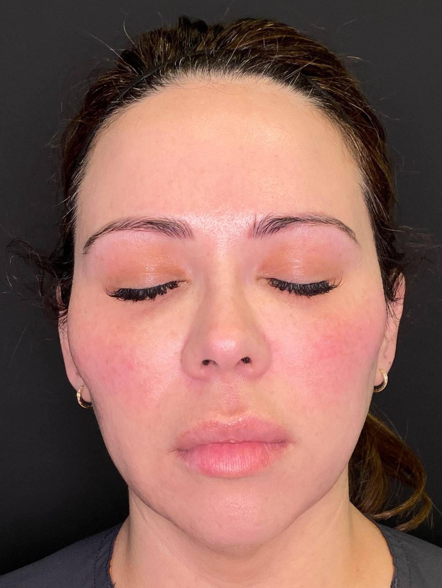Teoxane RHA Filler (8 Syringes RHA4) Case 1 After