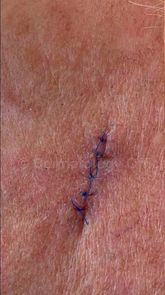 Cyst Removal Before and After Case-33 Before