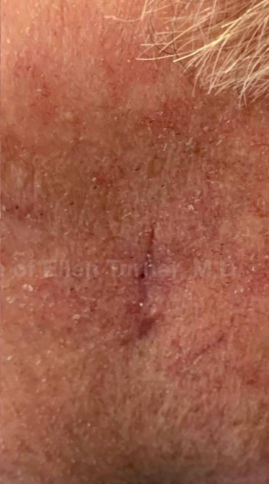 Cyst Removal Before and After Case-33 After