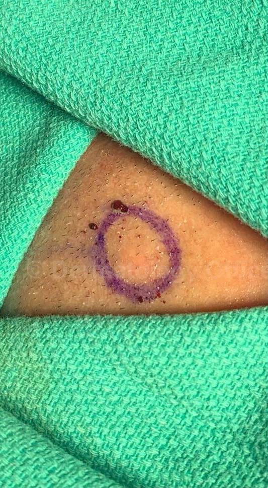 Cyst Removal Before and After Case-37 Before